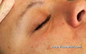 Crystal-Free Microdermabrasion Techniques DVD